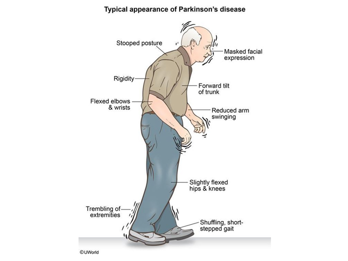تحقیق درباره بیماری پاركينسون